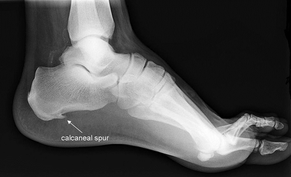 Pathologies > CALCANEAL Spur or Lenoir spur or calcaneal exostosis